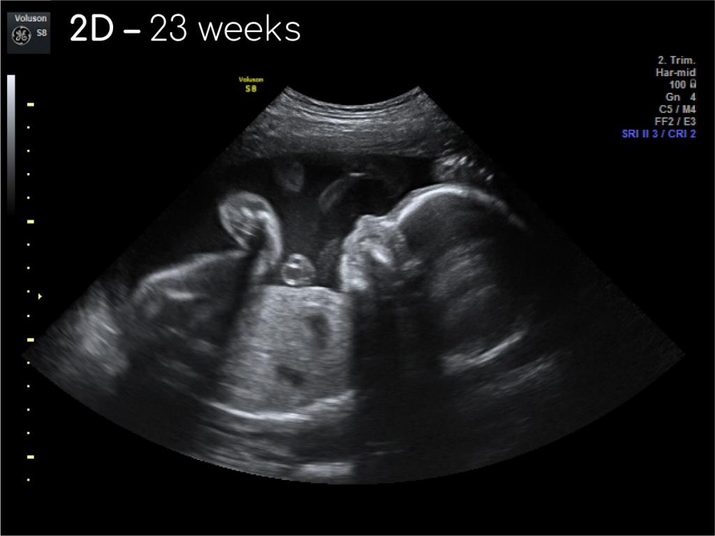 ➤ 23 неделя беременности всё что нужно знать будущей маме