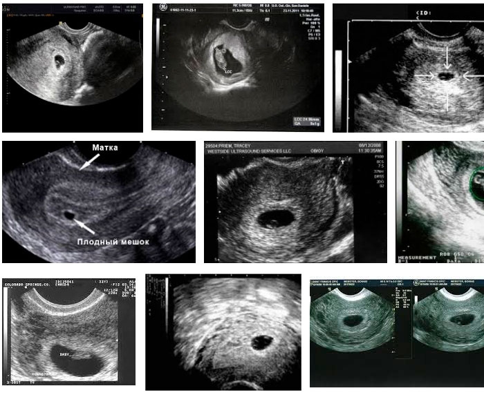 Как выглядит эмбрион в 5 недель беременности фото узи
