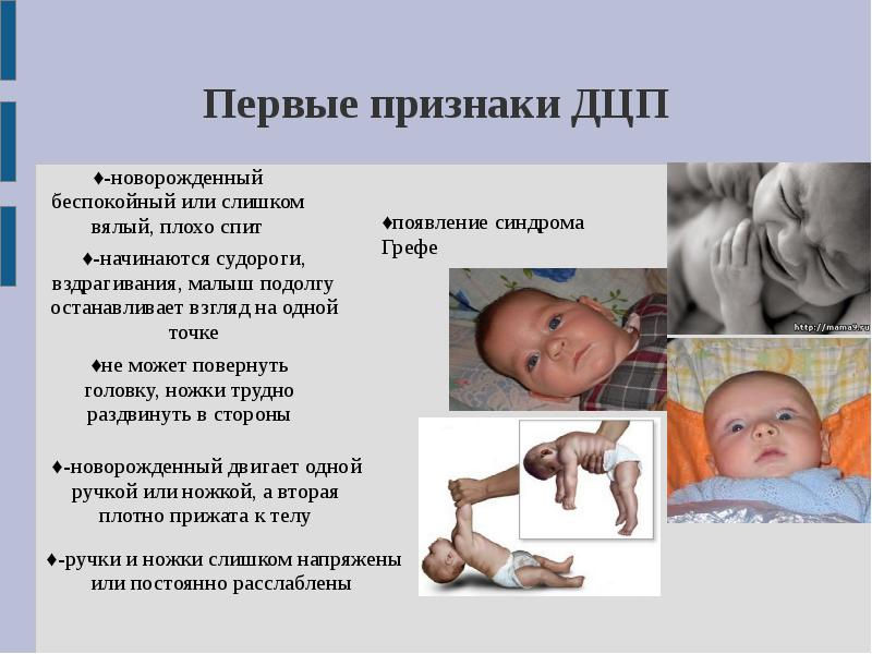 Дцп - детский церебральный паралич