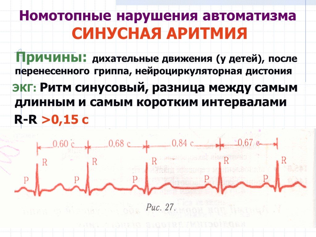 Синусовая аритмия сердца | медицинский центр «президент-мед»