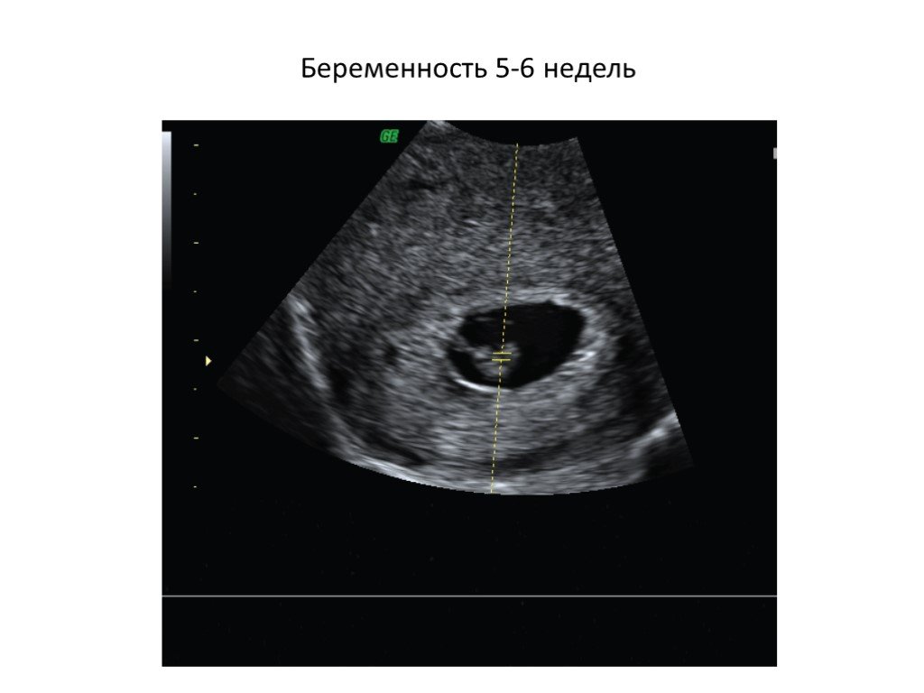 Как выглядит узи на 6 неделе. УЗИ 6 недель беременности. 5-6 Недель беременности фото плода на УЗИ.