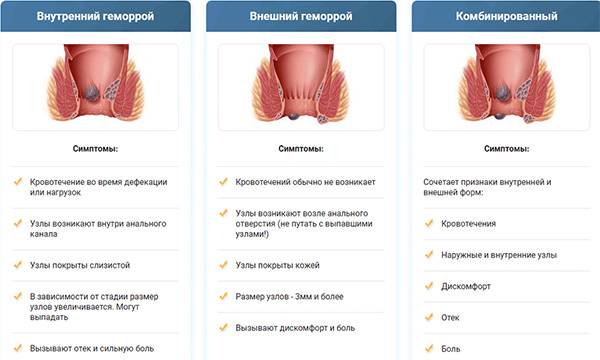 Можно ли избежать геморроя при беременности?
