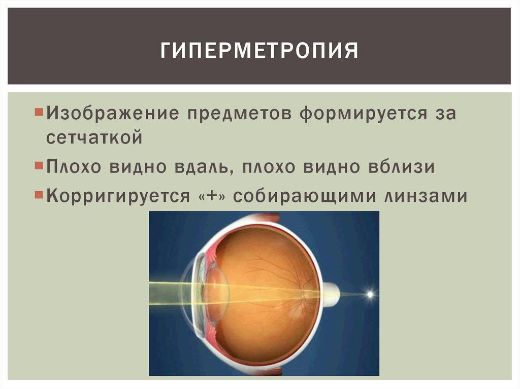 Дальнозоркость (гиперметропия): причины и коррекция. степени гиперметропии