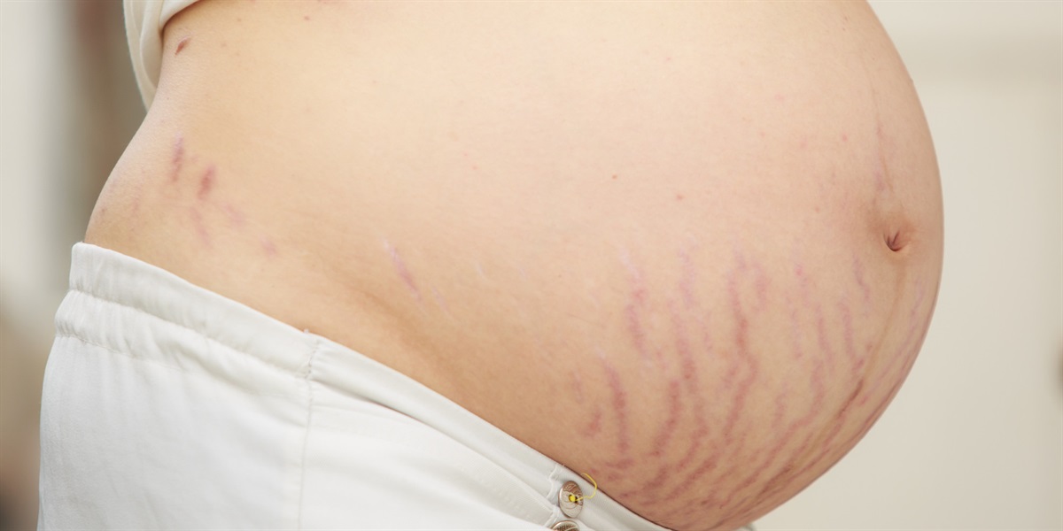 Удаление растяжек лазером или обертыванием после беременности