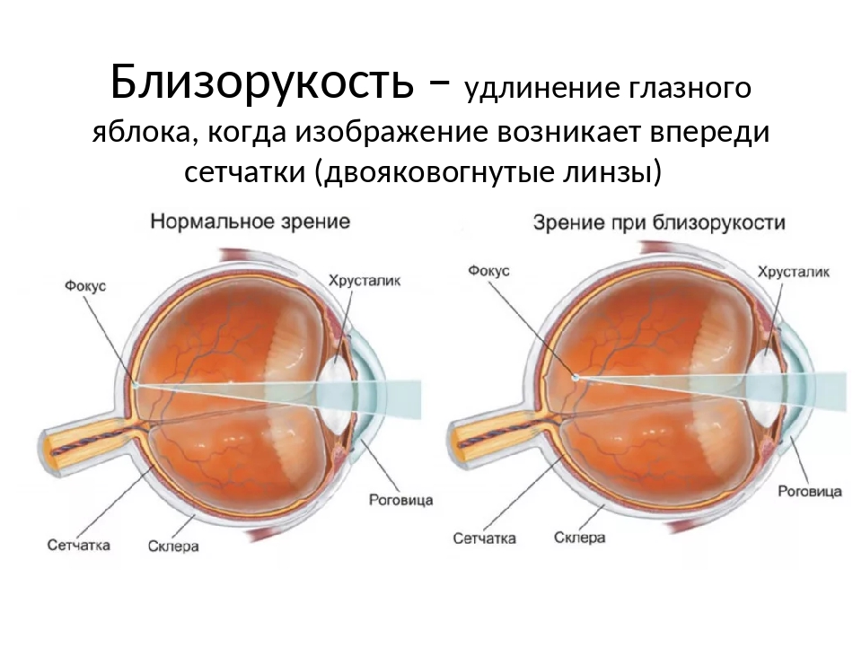 Врожденный астигматизм хрусталика - энциклопедия ochkov.net