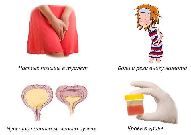 Цистит у женщин: лечение, симптомы и причины. рекомендации врача-гинеколога.