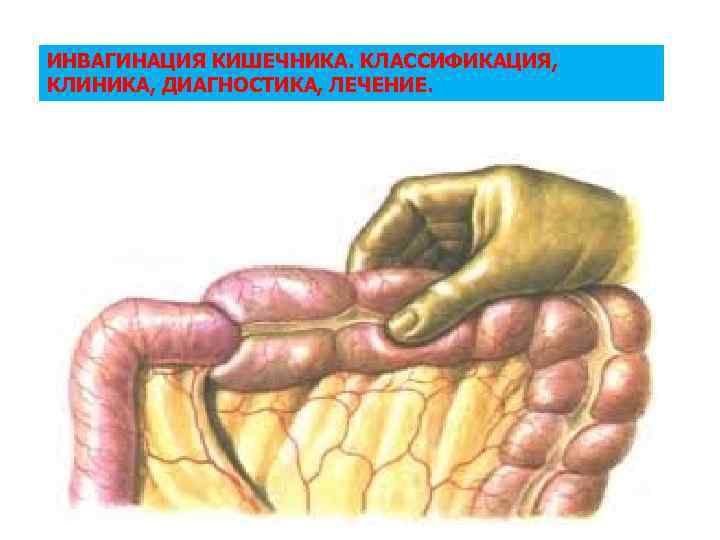 Инвагинация клиническая картина