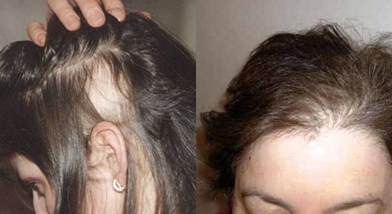 Выпадение волос: причины, профилактика и лечение