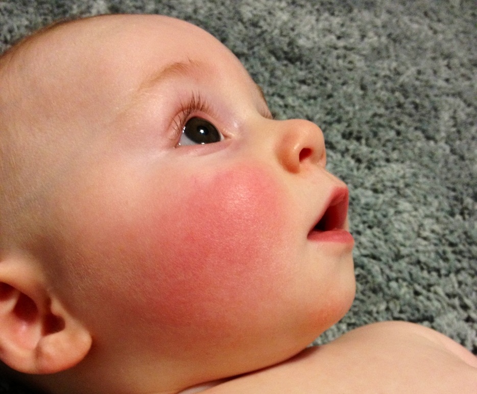 Аллергия у грудничка на лице: фото, лечение и симптомы аллергической сыпи у новорожденных детей