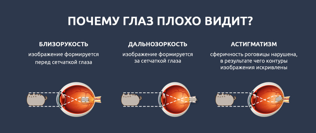 У близоруких людей изображение фокусируется перед сетчаткой на сосудистой