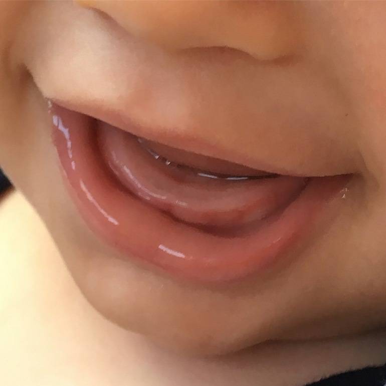 Лечение зубов у детей — методы и показания по лечению кариеса молочных зубов