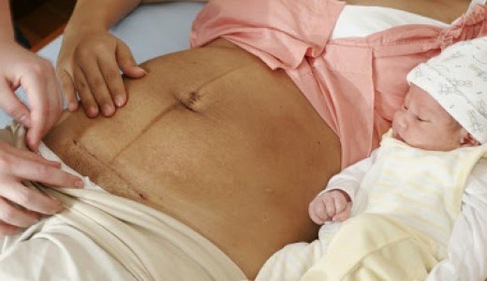 Не раз и не два. повторные операции кесарева сечения   | материнство - беременность, роды, питание, воспитание