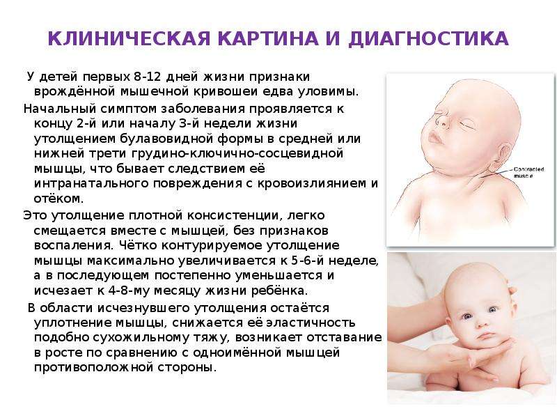Кривошея у новорожденных: признаки, причины, лечение, массаж, фото