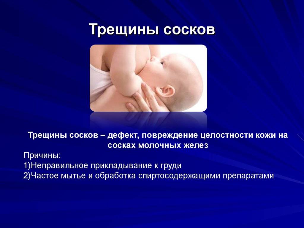 Как лечить трещины на сосках и почему они появляются?