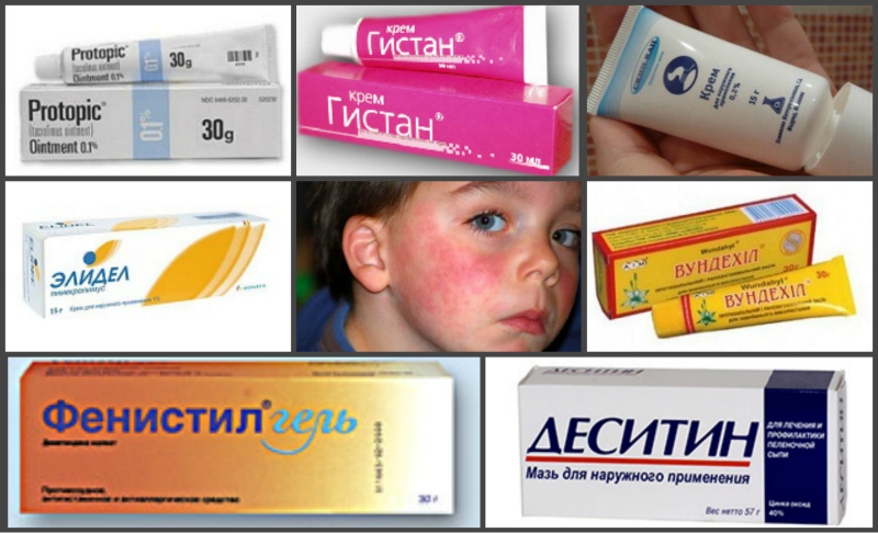 Аллергический дерматит у детей: фото, симптомы и лечение