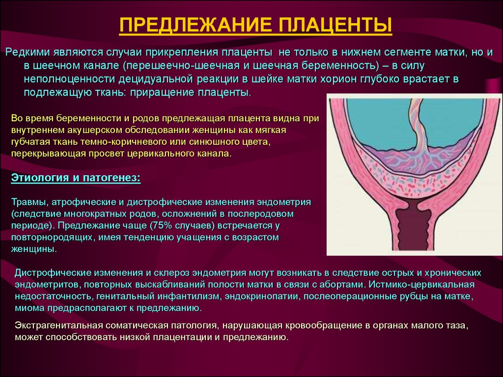 Предлежание сосудов – трагедия, которую можно предотвратить.
