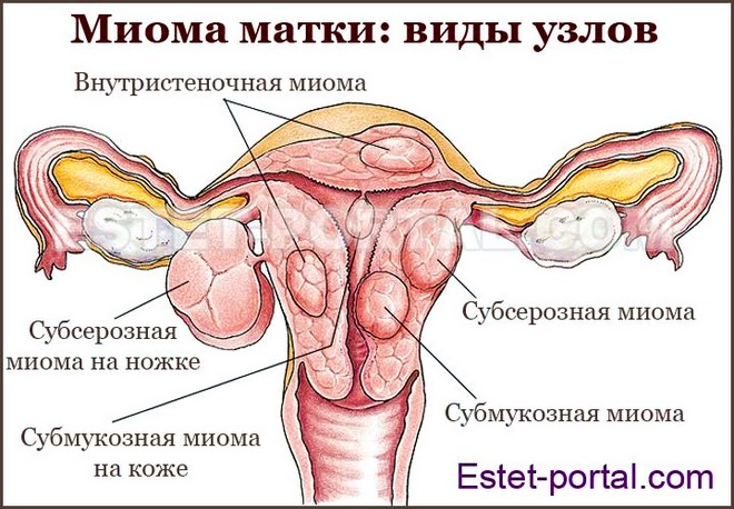 Миома матки: симптомы, признаки и лечение: советы гинеколога