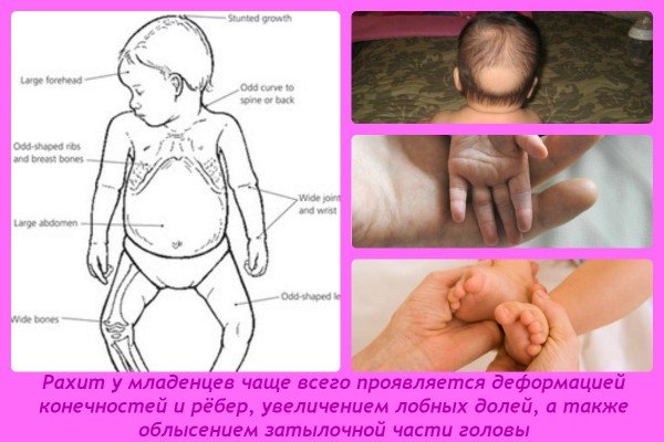 Все о рахите у грудных детей: симптомы, причины, лечение (профилактика и витамины). Последствия рахита