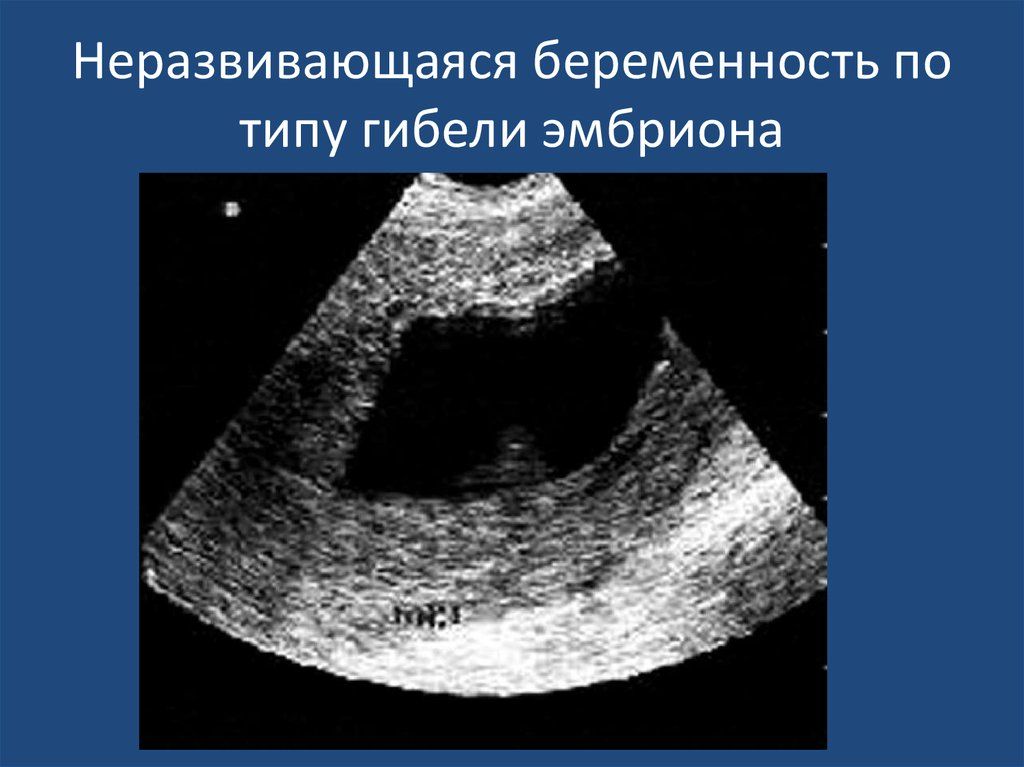 Замершая беременность на ранних сроках: способы прерывания, прогнозы