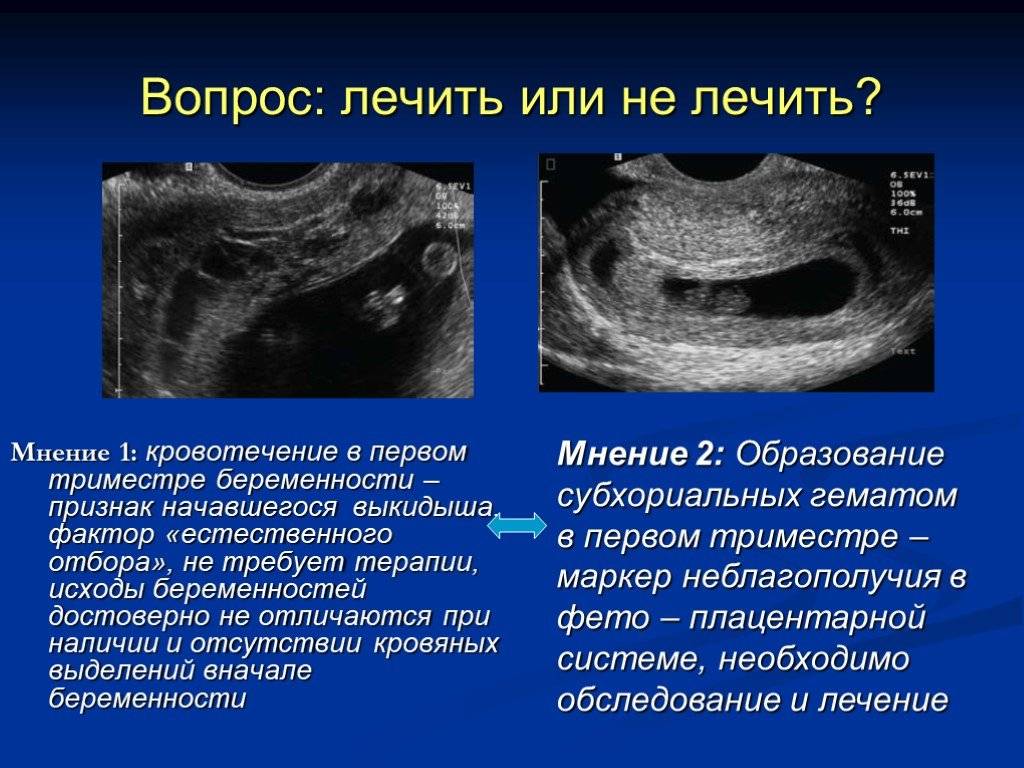 Кровить 6 недель беременности