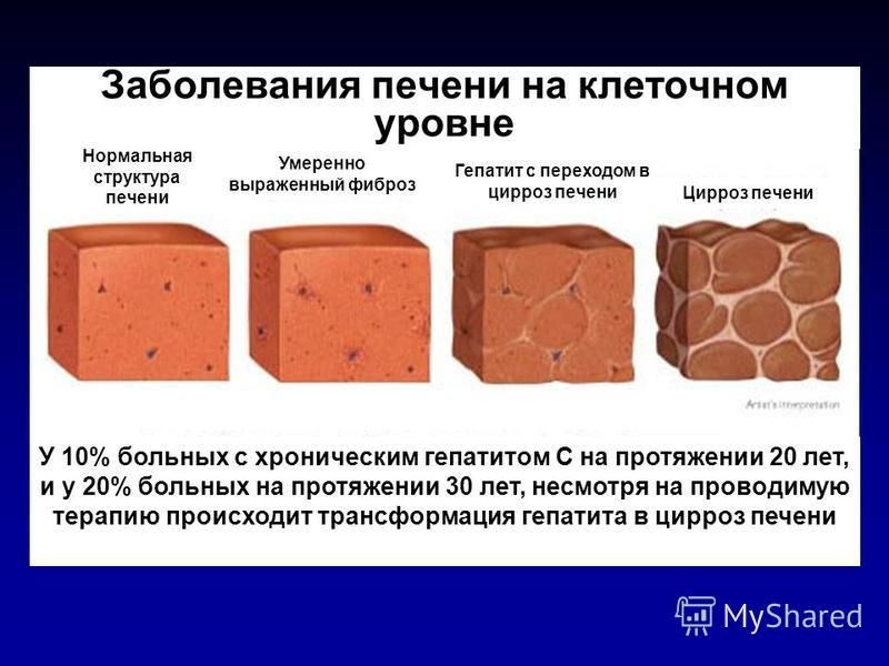 Неоднородное изменение печени. Крупнозернистая структура печени на УЗИ. Зернистая структура печени. Мелкозернистая структура печени. Крупнозернистая структура печени.