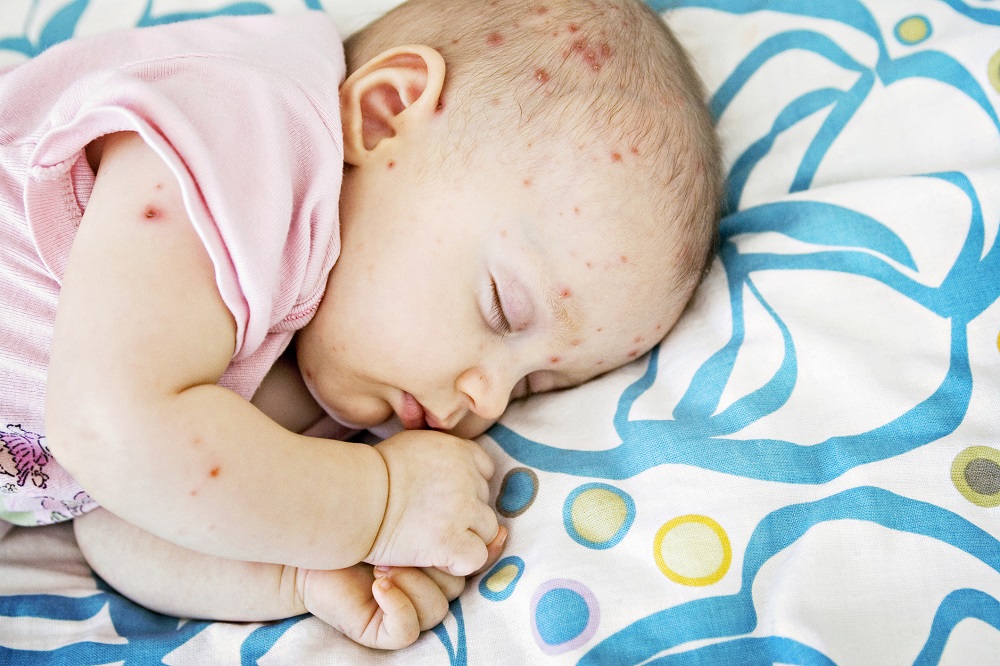 Аллергия у грудничка на лице: фото, лечение и симптомы аллергической сыпи у новорожденных детей