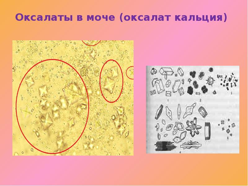 Кристаллы оксалата в моче у мужчин. Кристаллы оксалата кальция микроскопия. Соли оксалата кальция. Оксалаты кальция в моче под микроскопом. Оксалаты микроскопия мочи.