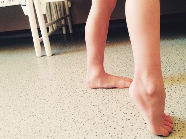 Доктор комаровский о том, почему ребенок ходит на носочках