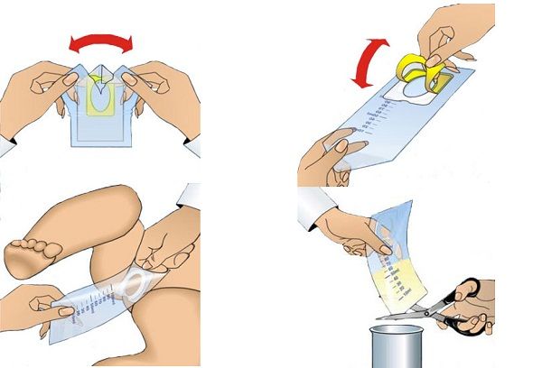 Мочеприемник для девочки как пользоваться фото