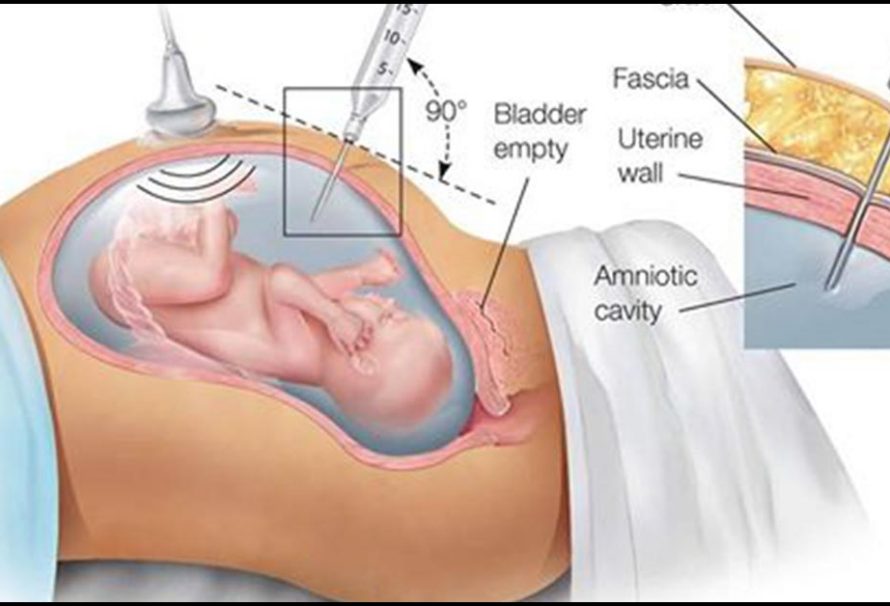 Причины появления взвесей в околоплодных водах при беременности, диагностика и методы лечения