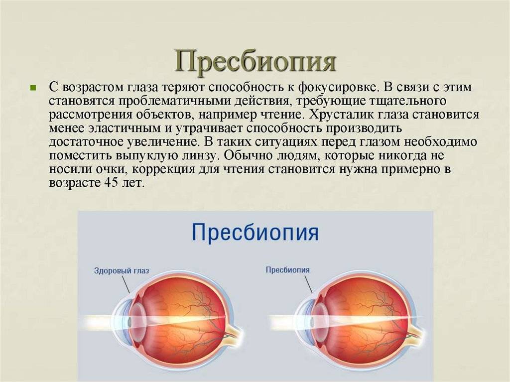 Миопический астигматизм обоих глаз, лечение сложного миопическиого астигматизма в клинике fedorovmedcenter.ru