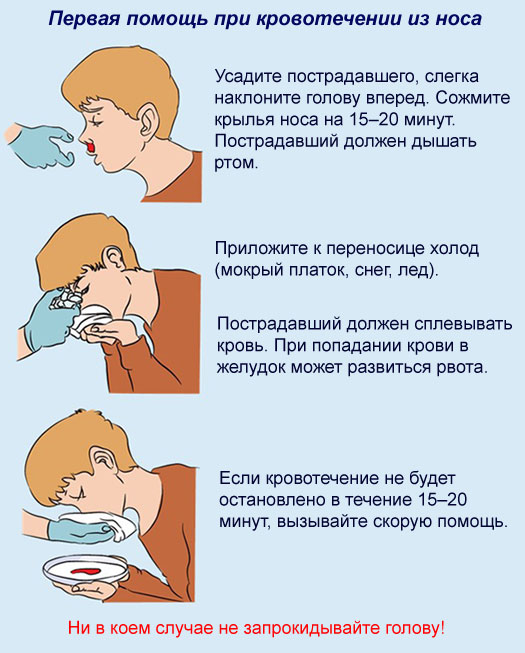 Кровотечение в домашних условиях. При носовом кровотечении холод накладывается на. При кровотечении из носа. Первая помощь при носовом кровотечении. Массовое кровотечение.
