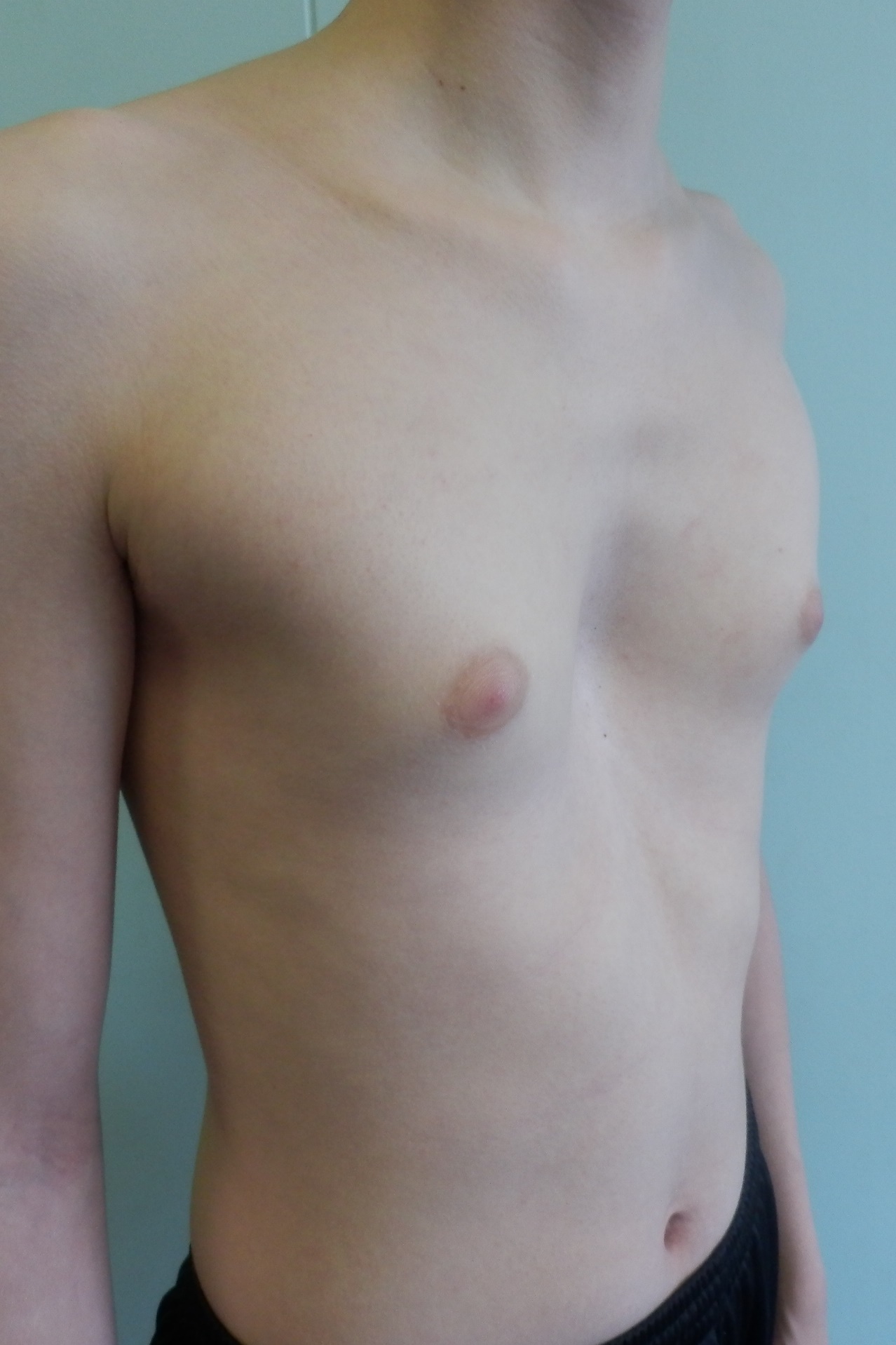 воронкообразная грудь у мужчин фото 13