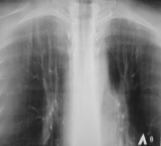 Рентген и гв - грудное вскармливание - страна мам