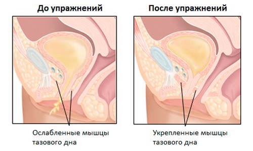 Укрепление мышц тазового дна