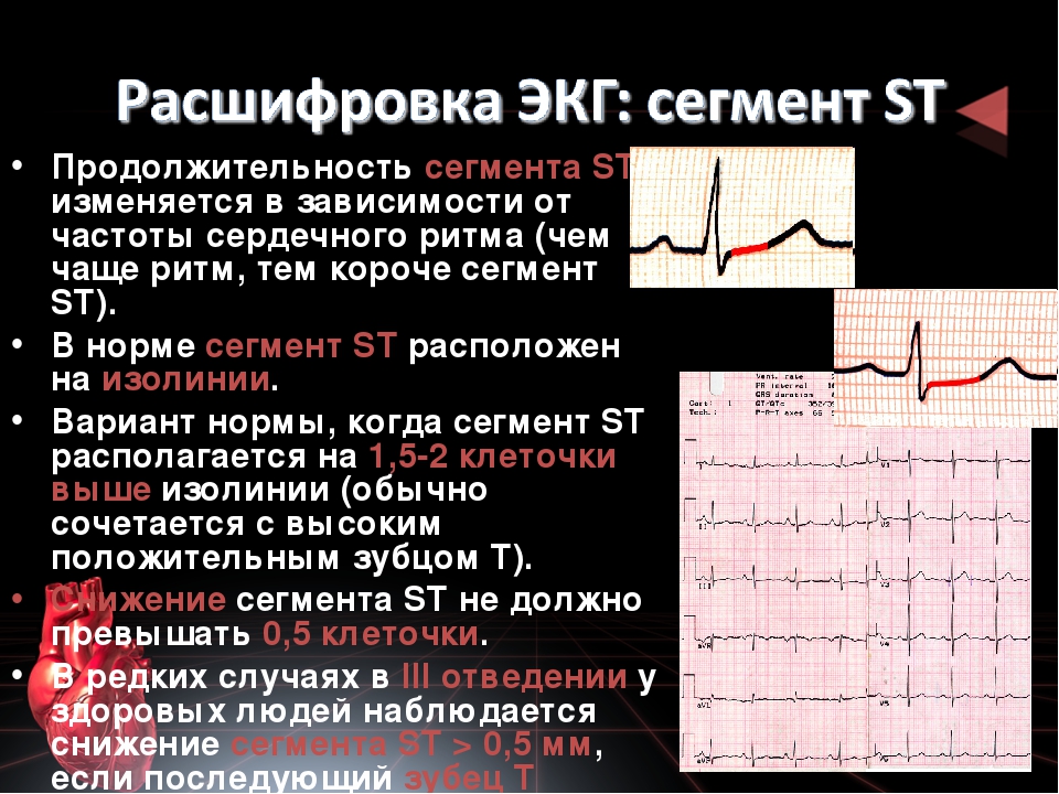 Расшифровка кардиограммы сердца по фото