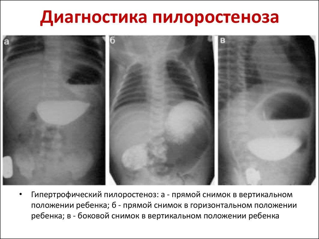 Пилоростеноз врожденный презентация