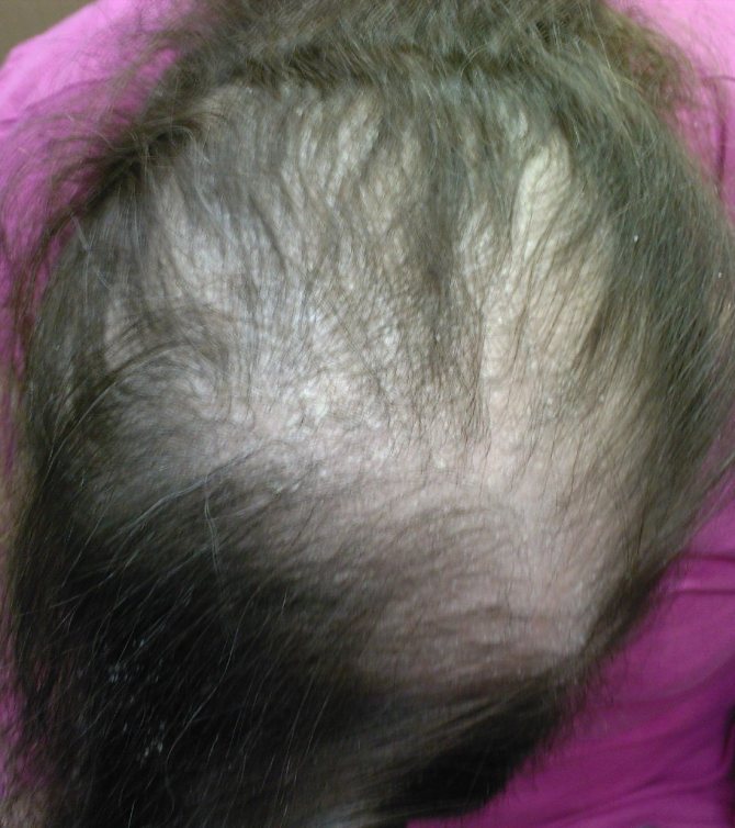 Выпадение волос после ковида - препараты и лечение алопеции после covid