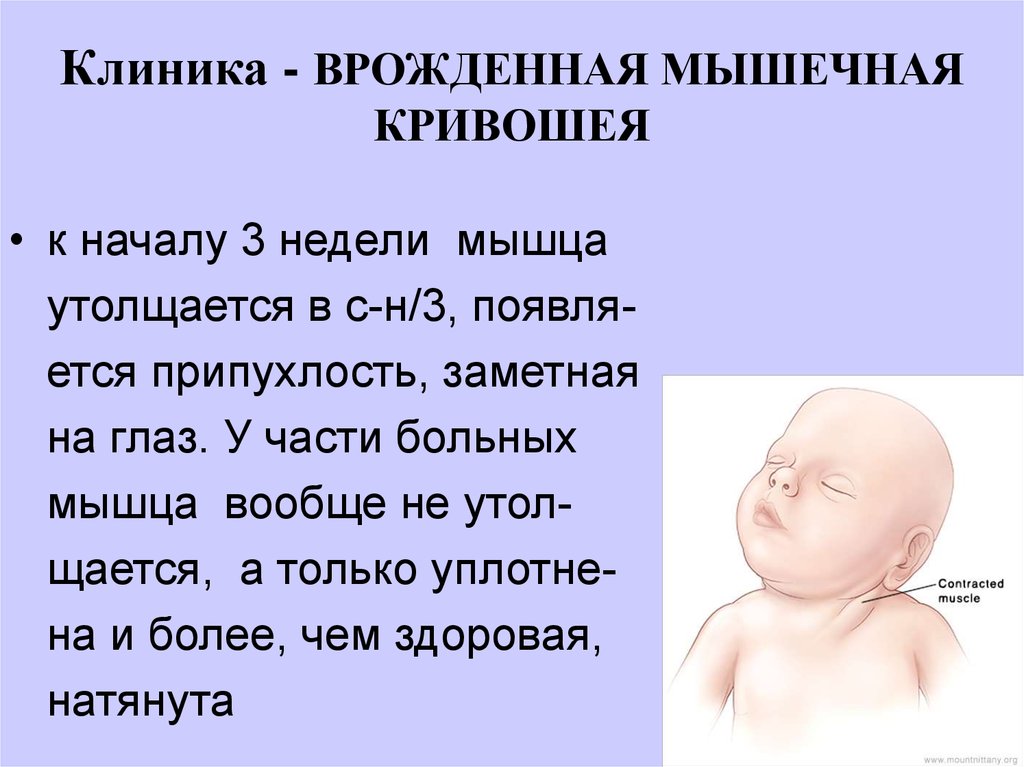 Что такое кривошея у новорожденного ребенка и детей до года: признаки, симптомы, причины, лечение в домашних условиях, комплекс упражнений