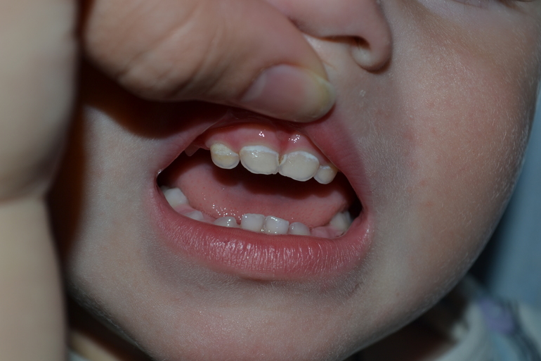 Кариес у детей: лечение, кариес молочных зубов, фото, симптомы, диагностика