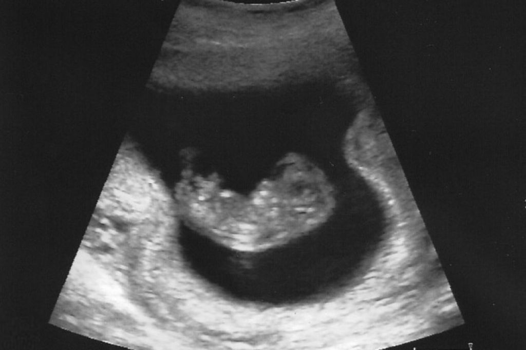 10 неделя что нового. УЗИ плода на 10 неделе беременности. Эмбрион на 10 неделе беременности УЗИ. УЗИ 10 недель беременности. 10 Недель беременности фото плода на УЗИ.