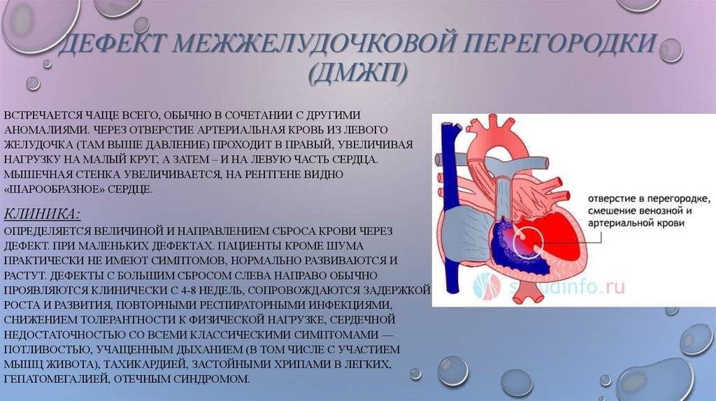 Дефект межпредсердной перегородки - симптомы, последствия, методы диагностики