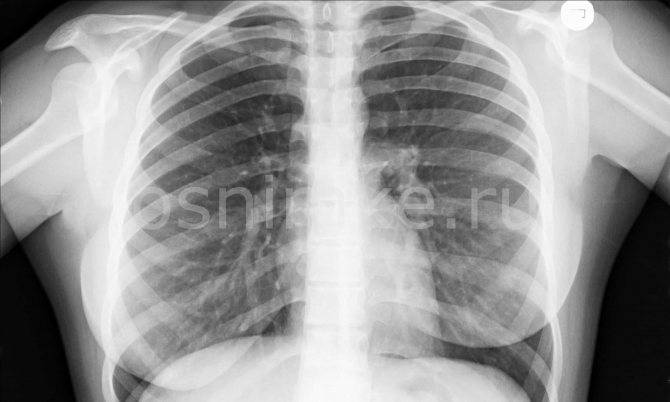 Рентген и флюорография при грудном вскармливании