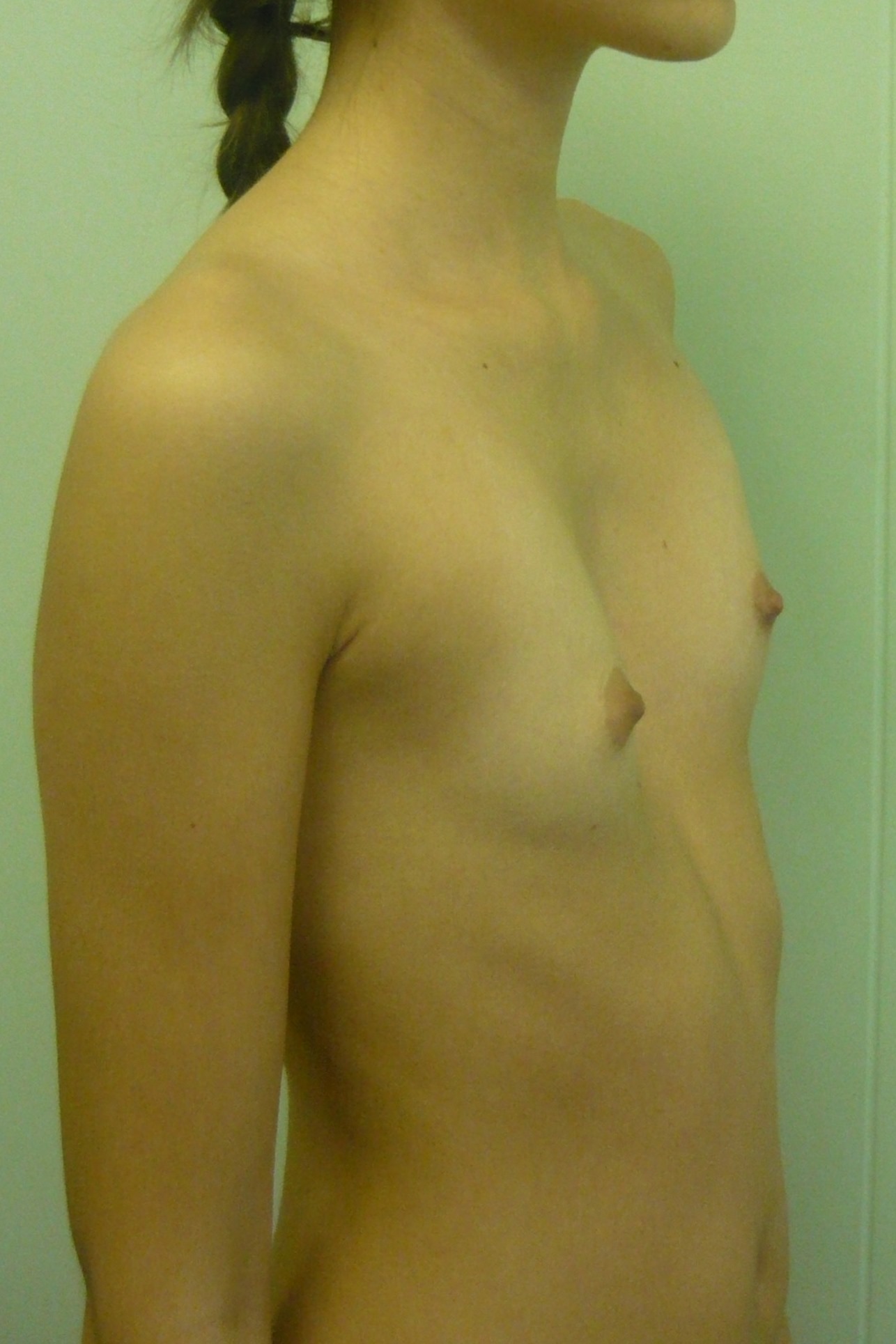 воронкообразная грудь у женщин фото 1