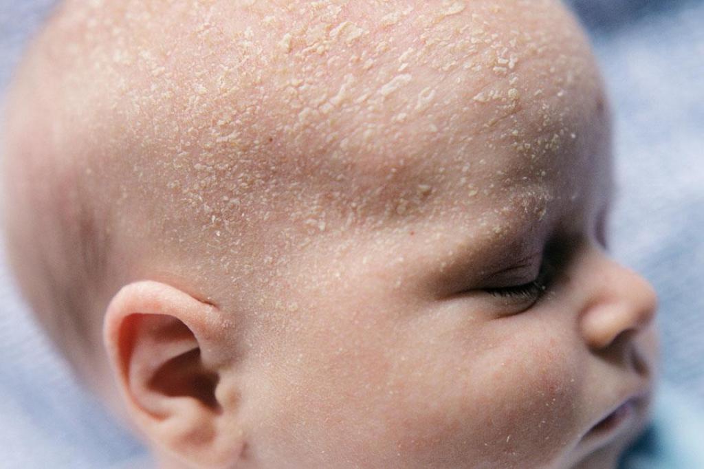 Себорея на голове у ребенка: причины, лечение, шампунь