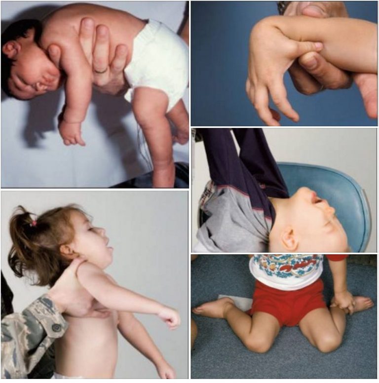 Гипотонус у ребенка: симптомы и лечение| нейроспектр
