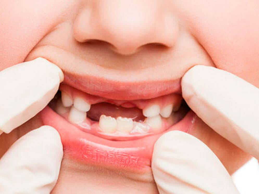 Портятся зубки у ребенка: бросать кормить или продолжать?