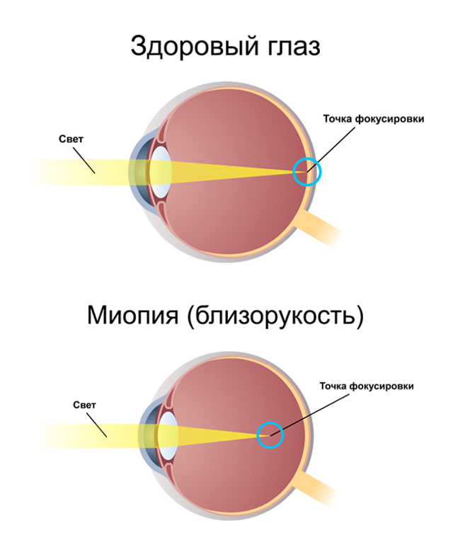 Где фокусируется изображение у дальнозорких людей