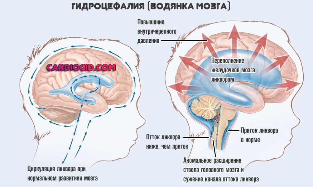 Синдром внутричерепной гипертензии патофизиологические механизмы клиническая картина