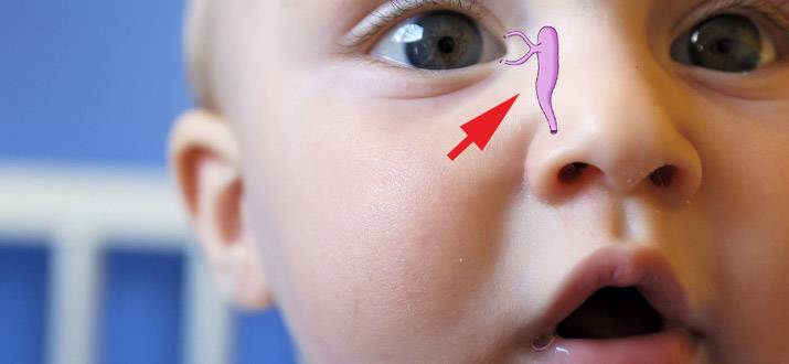 Дакриоцистит - зондирование слезного канала у детей